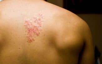 Comment se débarrasser du staphylocoque doré naturellement ?